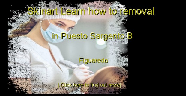 Skinart Learn how to removal in Puesto Sargento B  Figueredo-United Kingdom